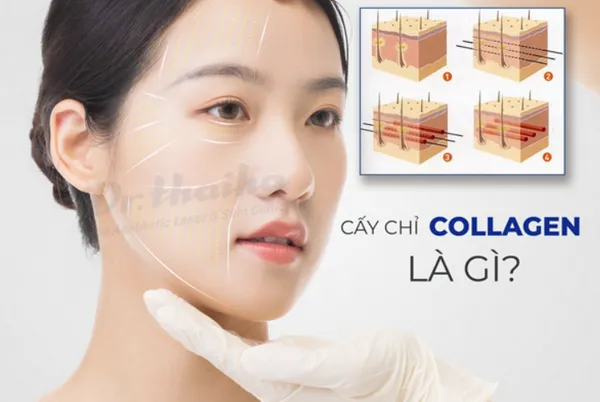 Cấy/ căng da mặt bằng chỉ collagen là gì? Những điều cần biết