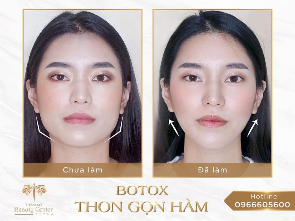 Feedback Khach Hang Tiem Botox Gon Ham 2