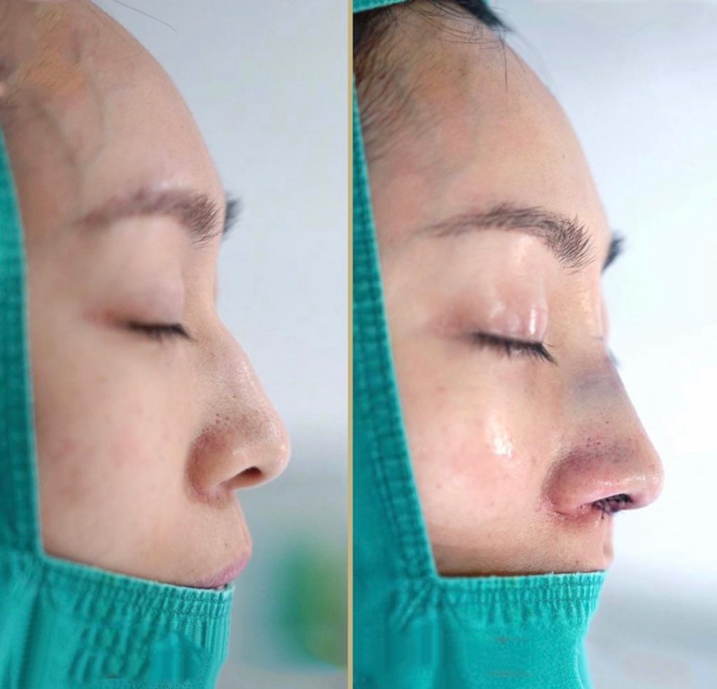 khách hàng nâng mũi surgiform tại thẩm mỹ beauty center by tấm