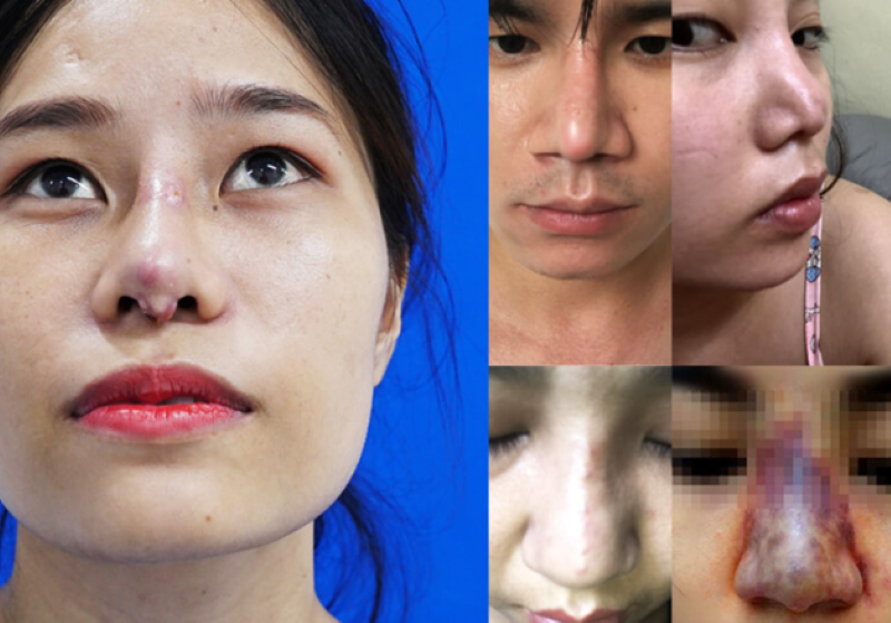 Những biến chứng tiêm filler mũi và các cách khắc phục hiệu quả