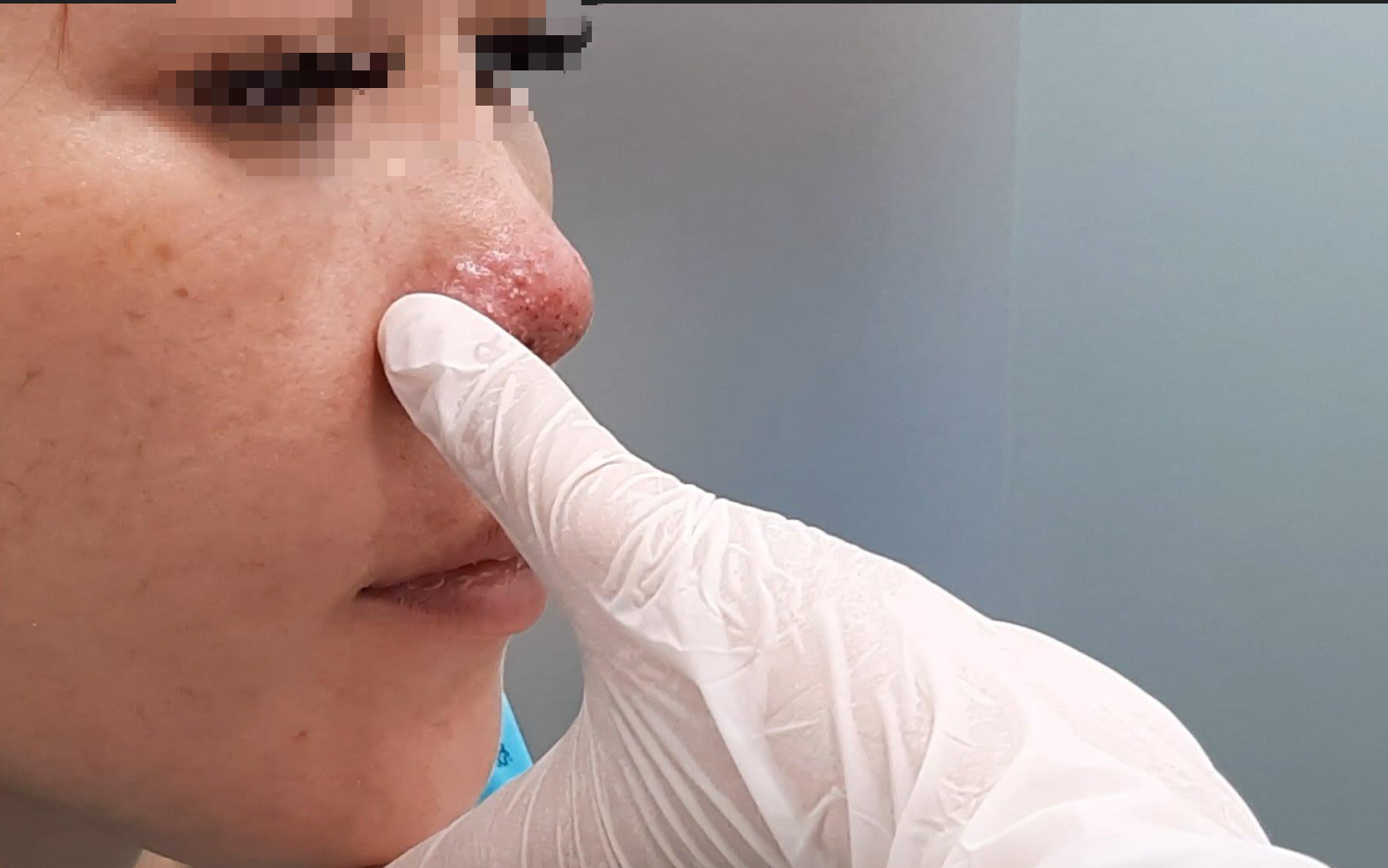 Tiêm filler nâng mũi ở spa, một phụ nữ ở Hà Nội bị biến chứng hoại tử