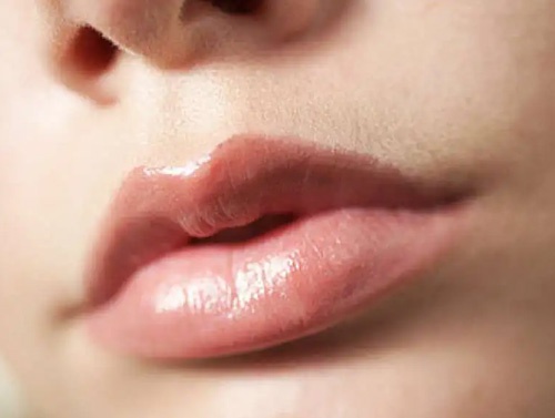 Tiêm filler môi bị sưng bao lâu? Sau bao lâu thì đẹp?