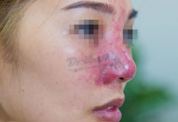 Hậu quả/ biến chứng khi tiêm filler mũi ở địa chỉ kém uy tín | Phòng khám Da liễu thẩm mỹ Bác sỹ Thái Hà