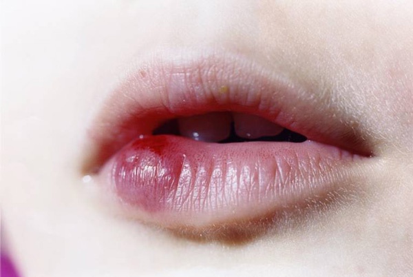 Những biến chứng có thể gặp khi tiêm filler môi