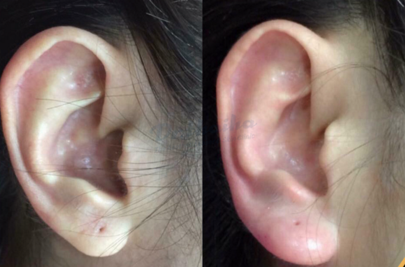 Tiêm filler tai phật và những vấn đề cần lưu ý